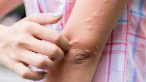 Mozzie bite