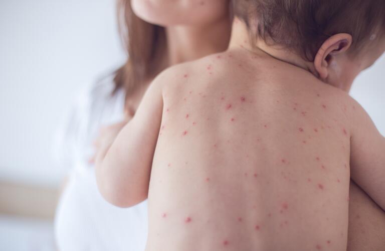 Flea bites